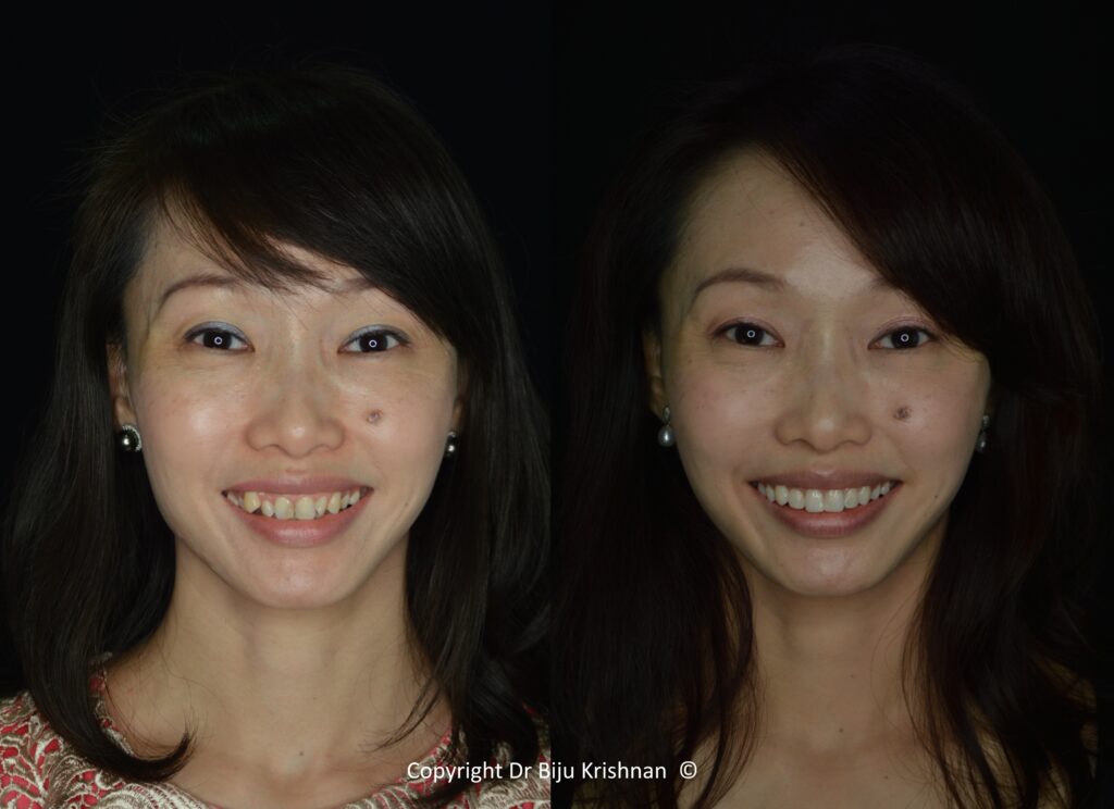 orthodontics ashford london smile makeover before and after dental veneers whitening straightening
