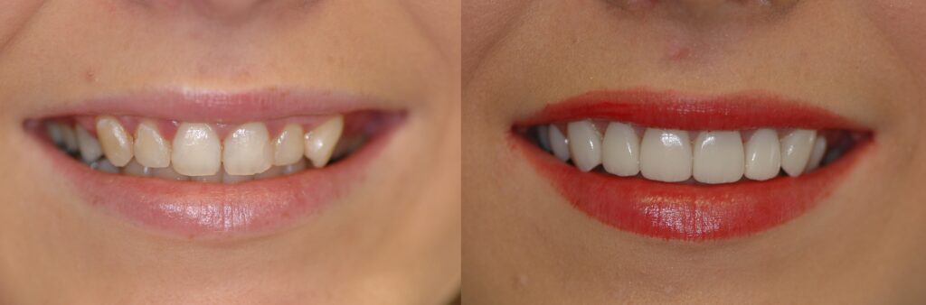 orthodontics ashford london smile makeover before and after dental veneers whitening straightening
