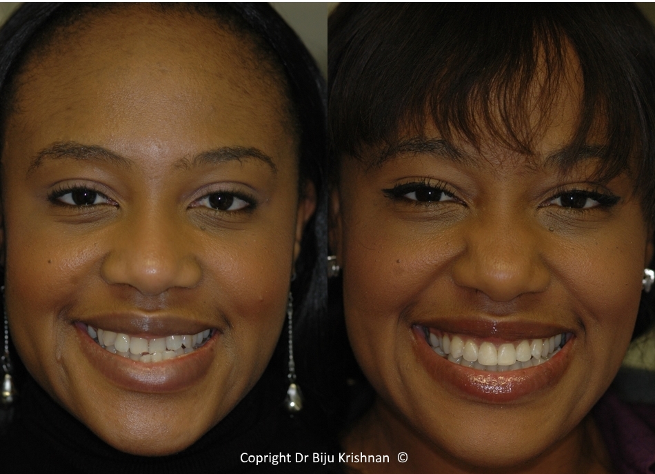 Orthodontics and Cosmetic Dentistry Smile Studio ashford london, smile makeover, before and after, dental veneers, whitening, straightening